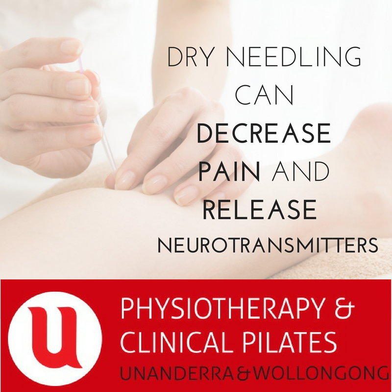 Five reasons you need to try Dry Needling | U Physiotherapy Unanderra